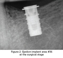 A retrospective survey of an implant, designed to resist bone loss